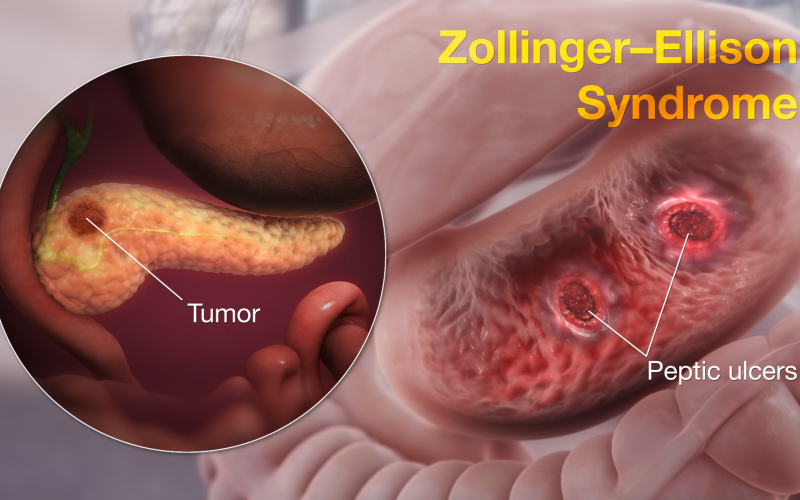 Zollinger-Ellison syndrome